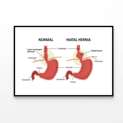 Hiatal Hernia & Normal Anatomy of The Stomach Home Decor Premium Quality Poster Print Choose Your Sizes