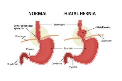 Hiatal Hernia & Normal Anatomy of The Stomach Home Decor Premium Quality Poster Print Choose Your Sizes