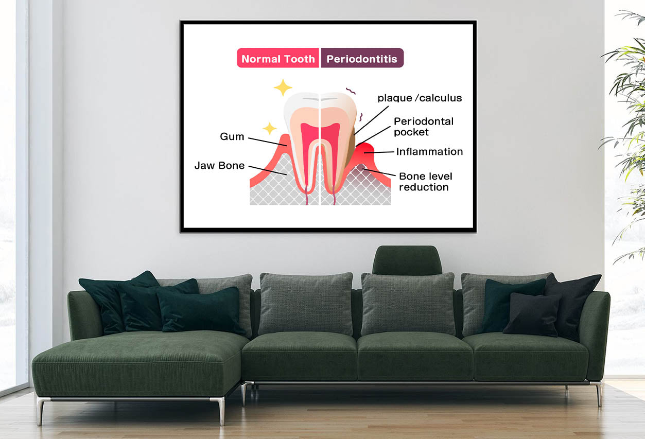 Normal Teeth & Periodontal Disease Home Decor Premium Quality Poster Print Choose Your Sizes