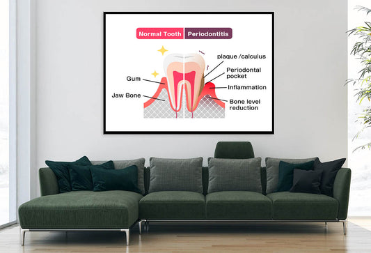 Normal Teeth & Periodontal Disease Home Decor Premium Quality Poster Print Choose Your Sizes