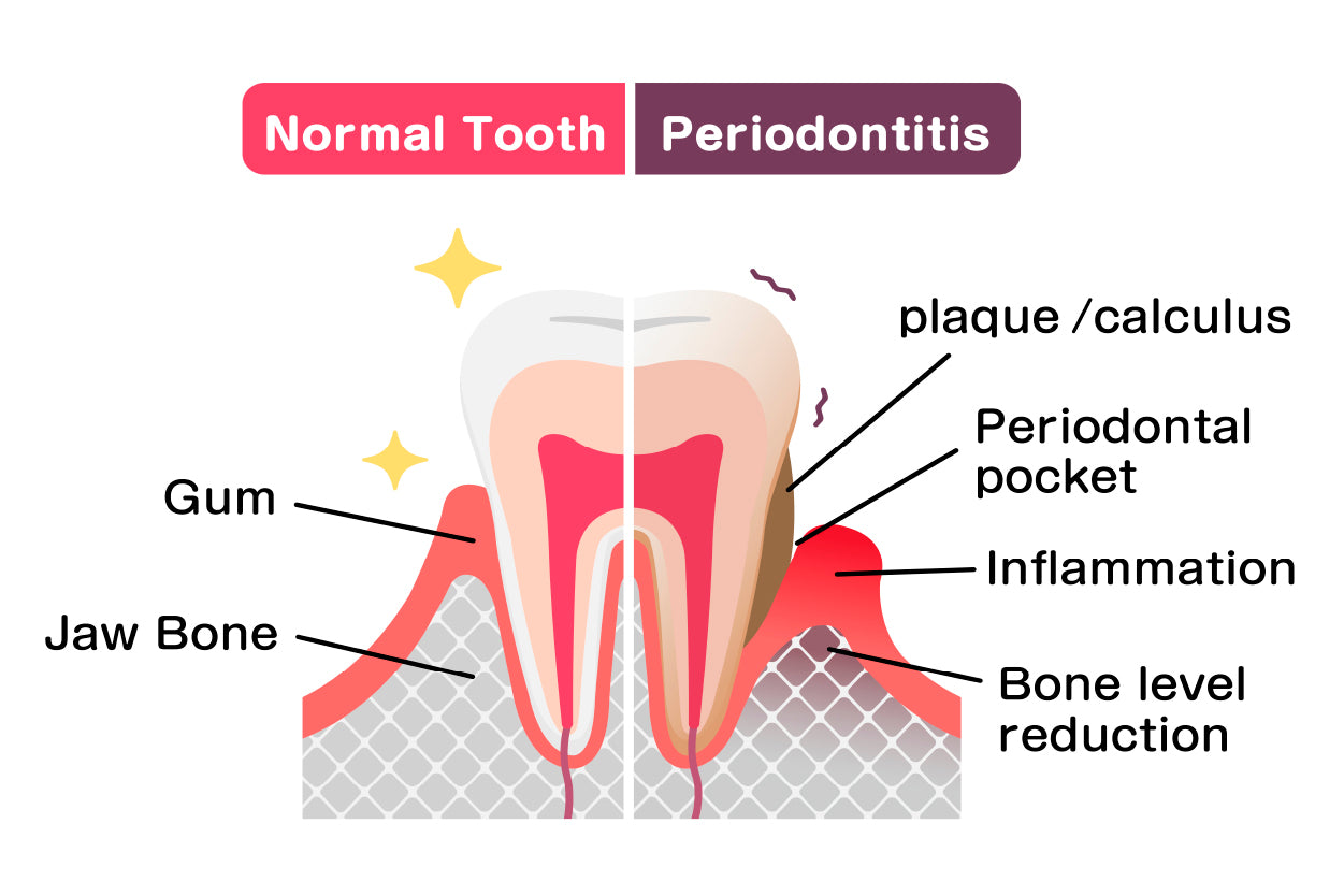 Normal Teeth & Periodontal Disease Home Decor Premium Quality Poster Print Choose Your Sizes