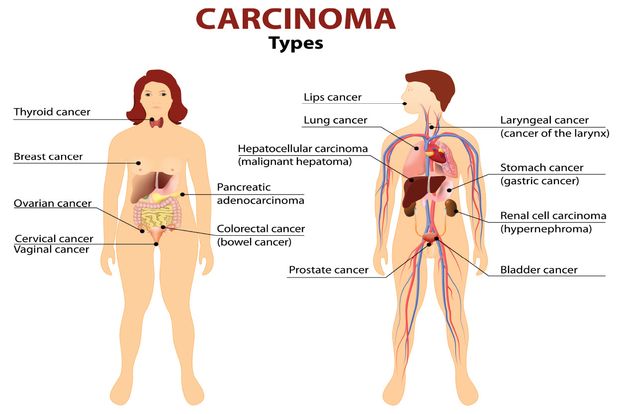 Carcinoma Illustration Home Decor Premium Quality Poster Print Choose Your Sizes