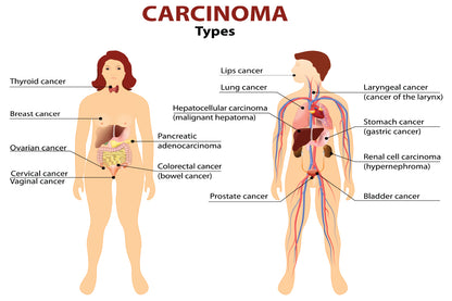 Carcinoma Illustration Home Decor Premium Quality Poster Print Choose Your Sizes