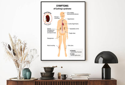 Cushing’s Disease and Syndrome Illustration Home Decor Premium Quality Poster Print Choose Your Sizes