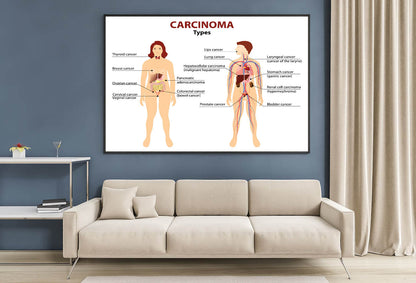 Carcinoma Illustration Home Decor Premium Quality Poster Print Choose Your Sizes