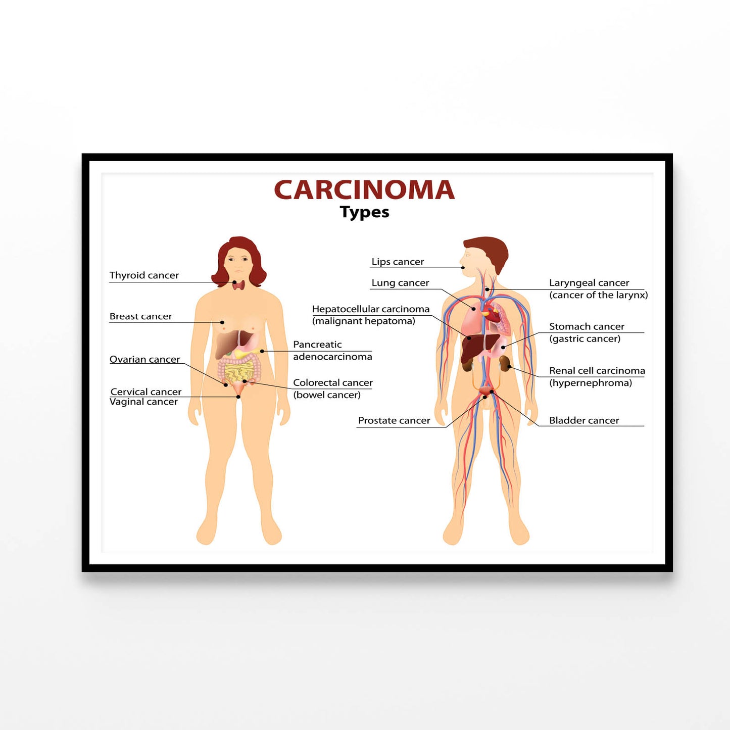 Carcinoma Illustration Home Decor Premium Quality Poster Print Choose Your Sizes