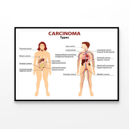 Carcinoma Illustration Home Decor Premium Quality Poster Print Choose Your Sizes