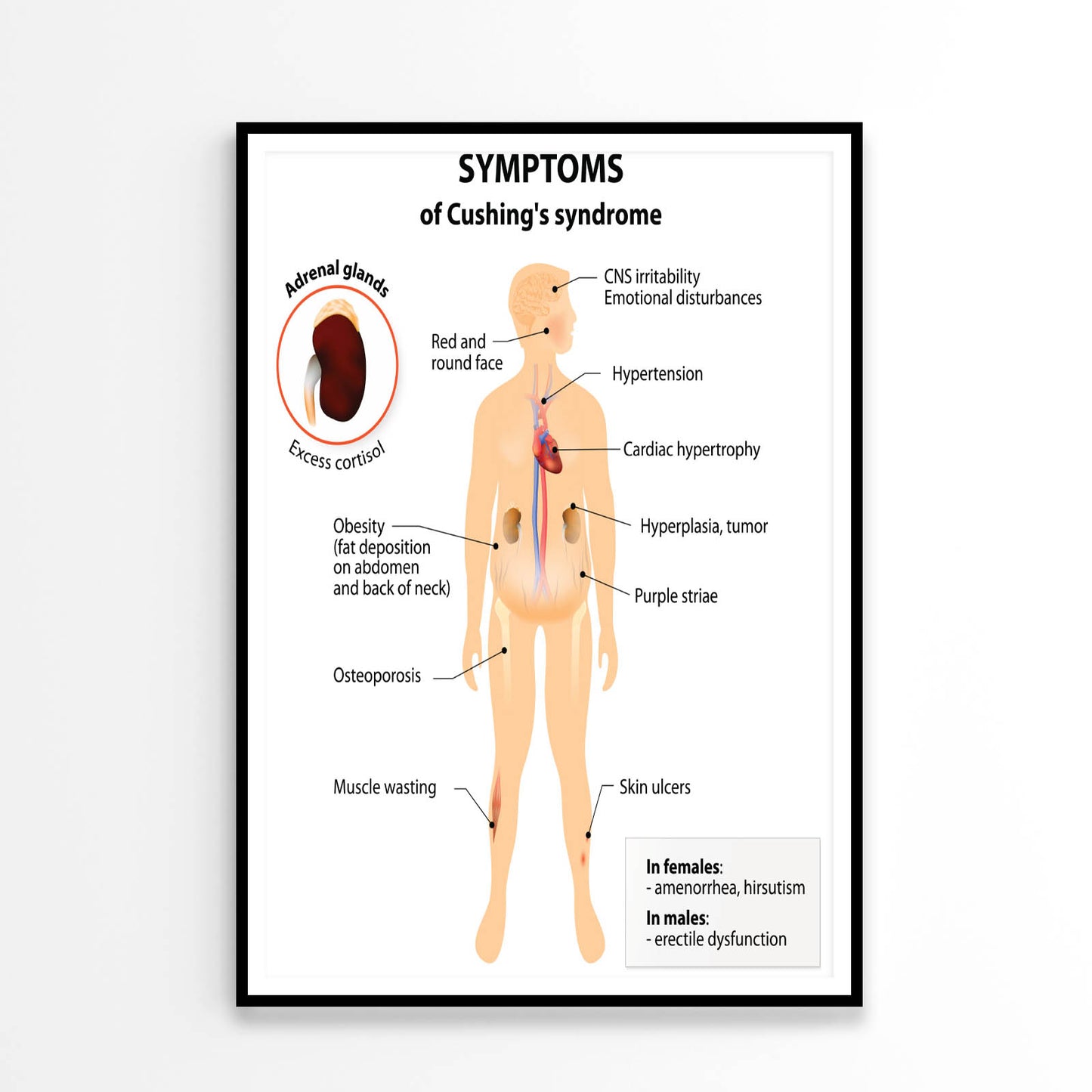 Cushing’s Disease and Syndrome Illustration Home Decor Premium Quality Poster Print Choose Your Sizes