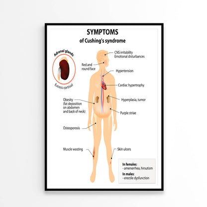 Cushing’s Disease and Syndrome Illustration Home Decor Premium Quality Poster Print Choose Your Sizes