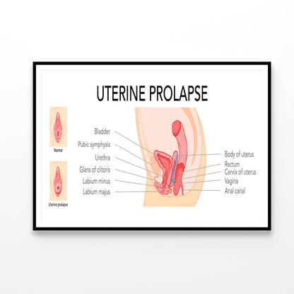 Uterine Prolapse Female Reproductive System Home Decor Premium Quality Poster Print Choose Your Sizes