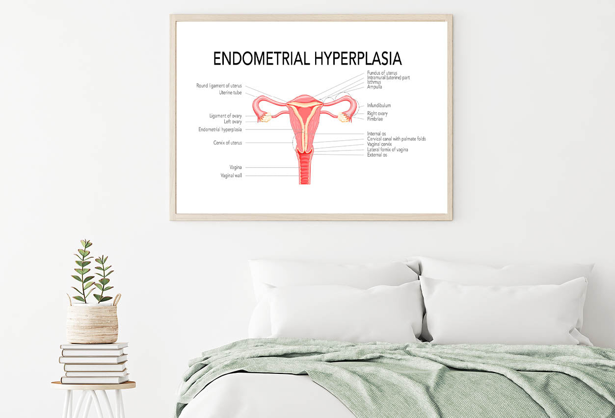 Endometrial Hyperplasia, Medical Diagram Home Decor Premium Quality Poster Print Choose Your Sizes