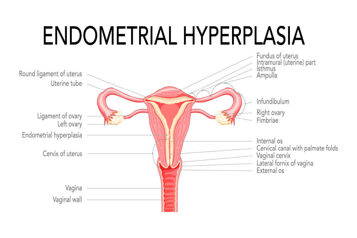 Endometrial Hyperplasia, Medical Diagram Home Decor Premium Quality Poster Print Choose Your Sizes