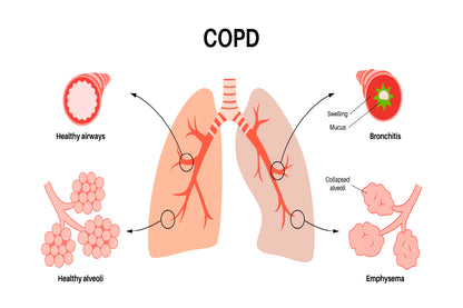 Chronic Obstructive Pulmonary Disease Home Decor Premium Quality Poster Print Choose Your Sizes