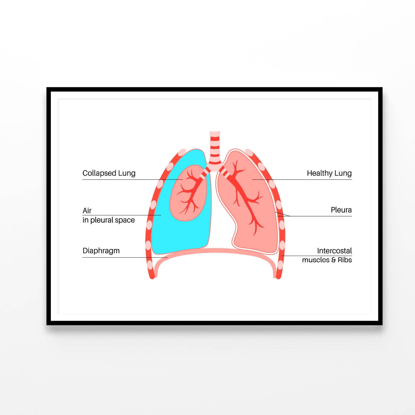 Pneumothorax Anatomical Illustration Home Decor Premium Quality Poster Print Choose Your Sizes