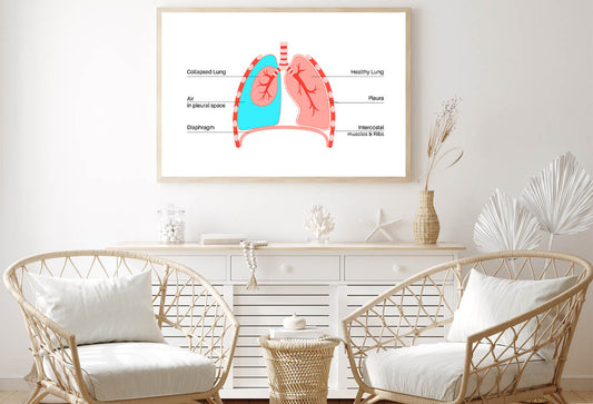 Pneumothorax Anatomical Illustration Home Decor Premium Quality Poster Print Choose Your Sizes