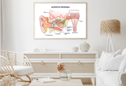 Acoustic Neuroma Home Decor Premium Quality Poster Print Choose Your Sizes