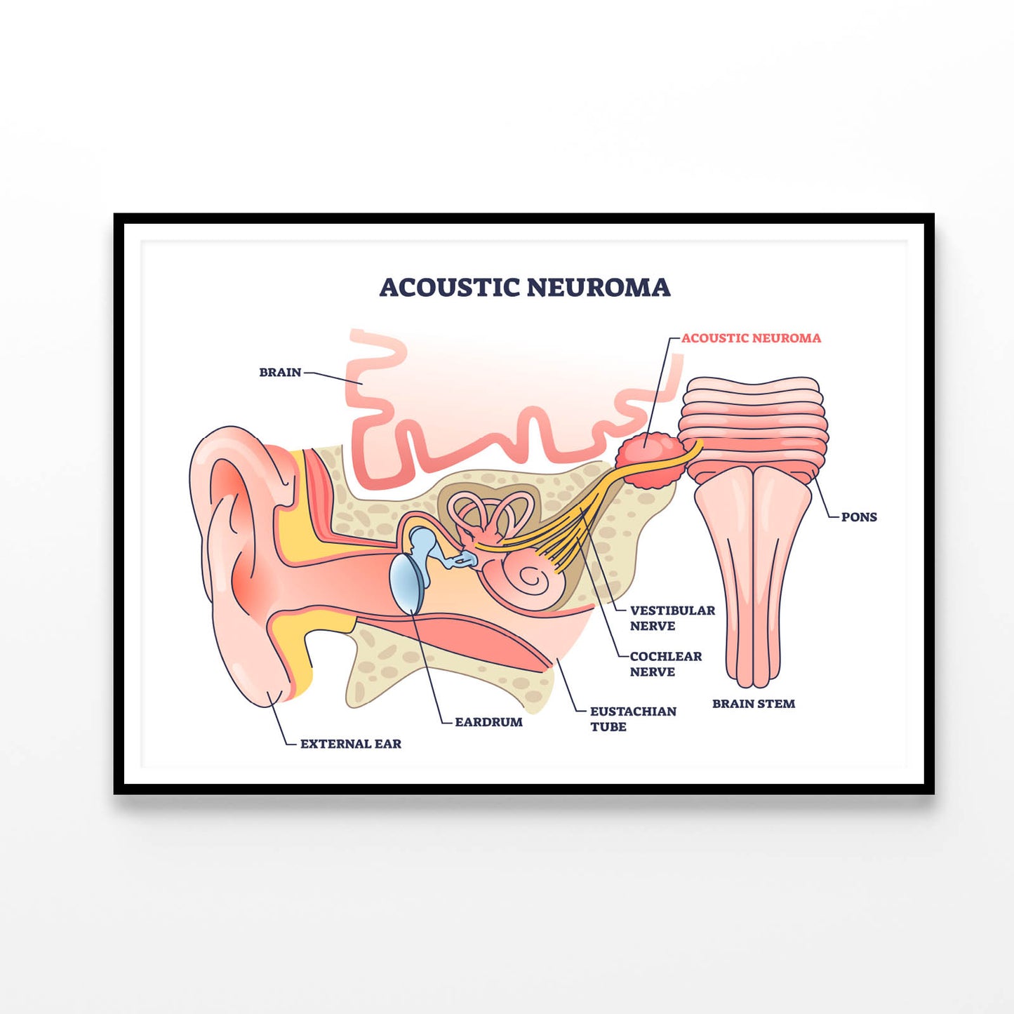 Acoustic Neuroma Home Decor Premium Quality Poster Print Choose Your Sizes