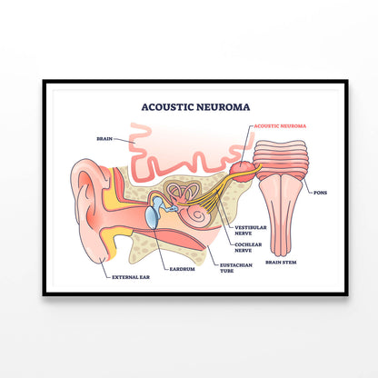 Acoustic Neuroma Home Decor Premium Quality Poster Print Choose Your Sizes