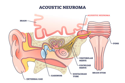 Acoustic Neuroma Home Decor Premium Quality Poster Print Choose Your Sizes