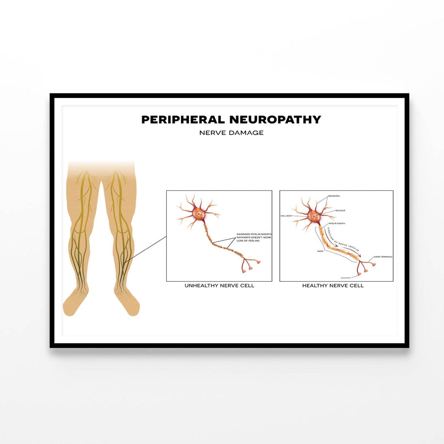 Neuropathy, Nerve Damage Illustration Home Decor Premium Quality Poster Print Choose Your Sizes