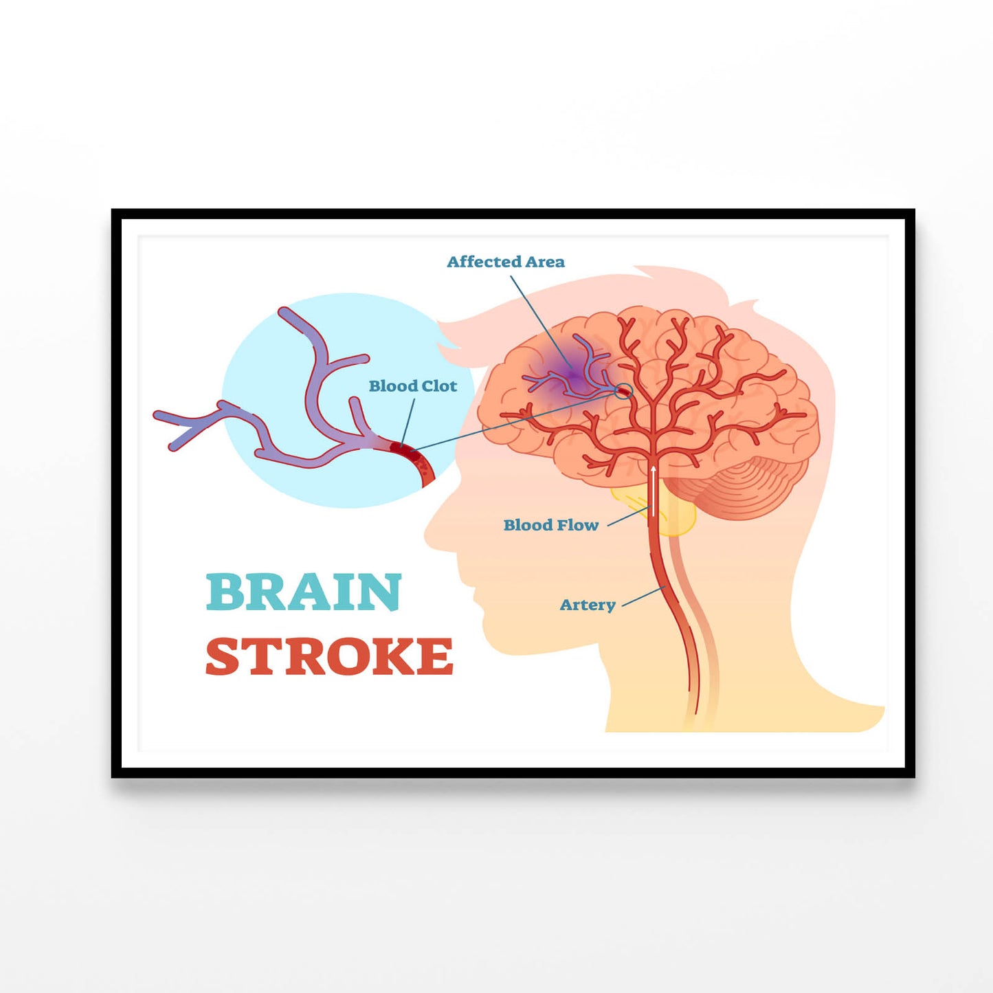 Brain Stroke Anatomical Vector Diagram Home Decor Premium Quality Poster Print Choose Your Sizes