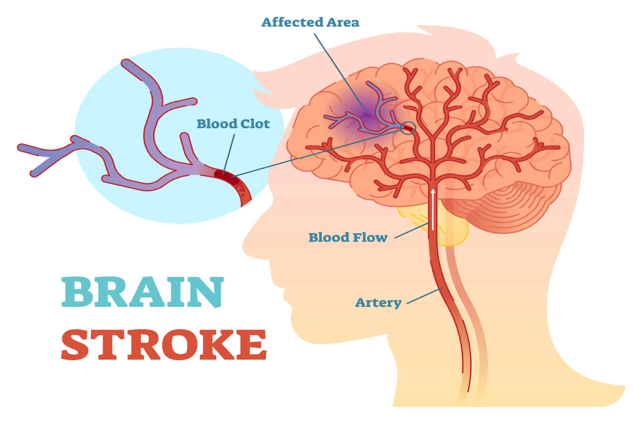 Brain Stroke Anatomical Vector Diagram Home Decor Premium Quality Poster Print Choose Your Sizes