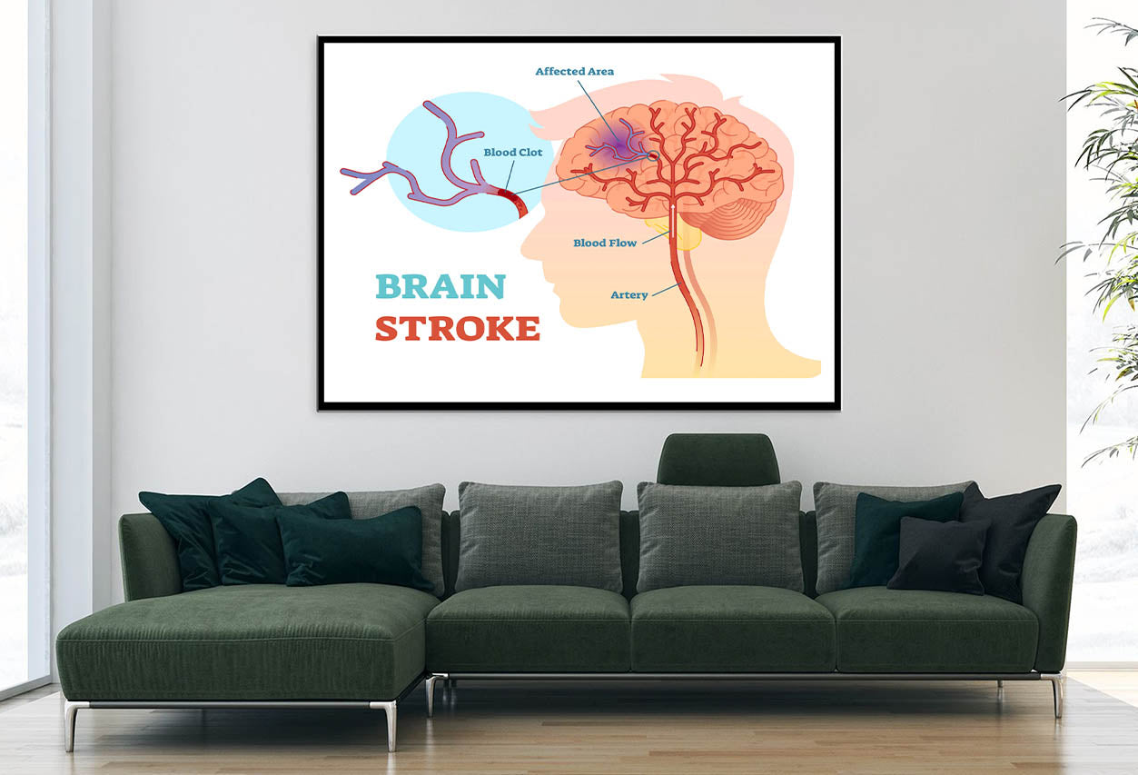 Brain Stroke Anatomical Vector Diagram Home Decor Premium Quality Poster Print Choose Your Sizes